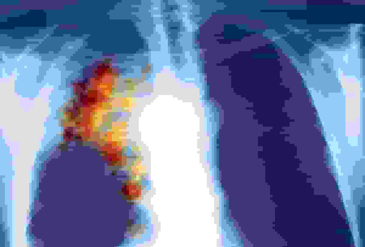 شرکت سامیت درمانی برای تأیید داروی سرطان ریه درخواست میدهد علیرغم هشدار تنظیمکننده آمریکایی