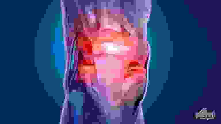 آرتروز: زنگ خطر درد و ناتوانی زودرس برای جوانان فعال