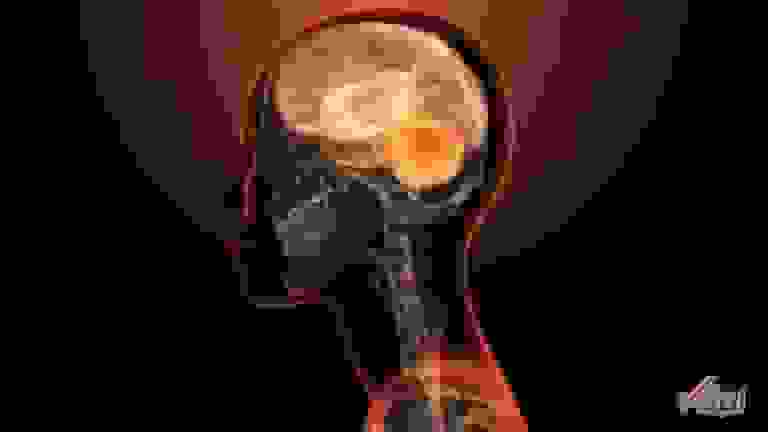 کشف اولین ژن منفرد عامل مستقیم بیماری‌های روانی