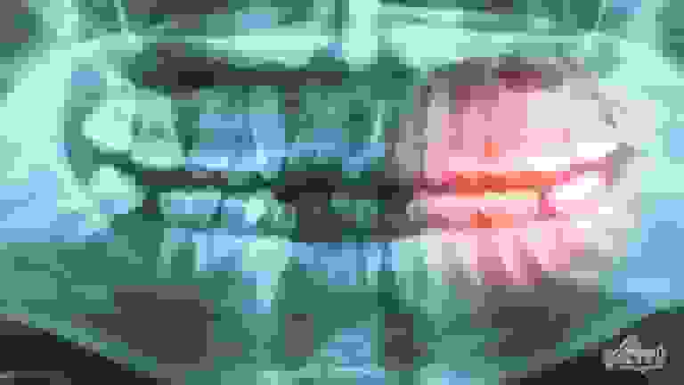 ارتباط بیماری لثه با افزایش خطر بیماری‌های قلبی