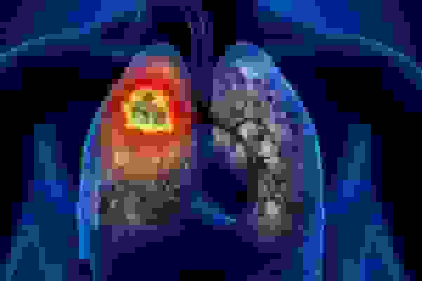 فناوری هسته‌ای، سلاحی نو در تشخیص کشنده‌ترین سرطان جهان