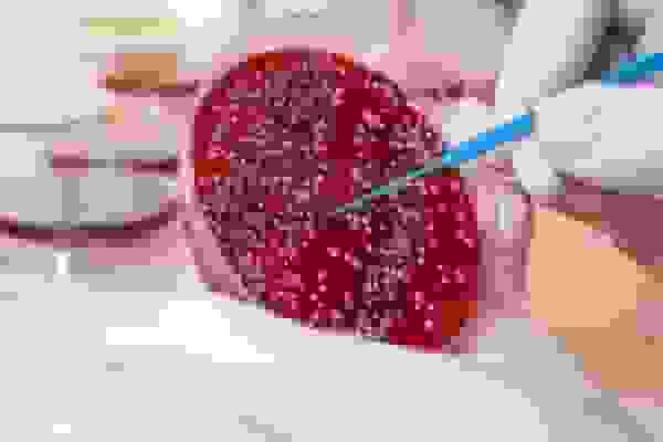 ابداع روش سه‌گانه برای درمان سرطان خون