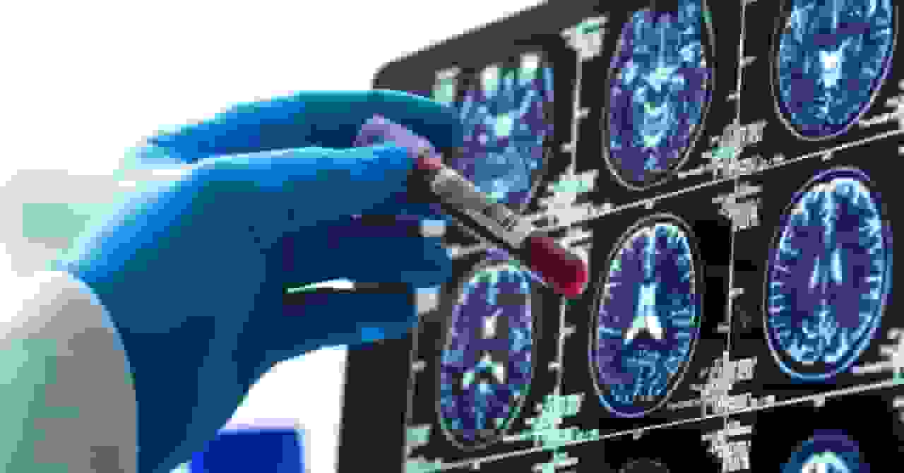 آزمایش خون برای آلزایمر وارد بازار شد