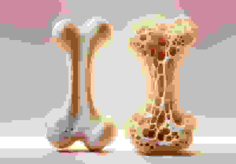 سالانه ۱۵۰ هزار شکستگی ناشی از پوکی استخوان در ایران رخ می‌دهد