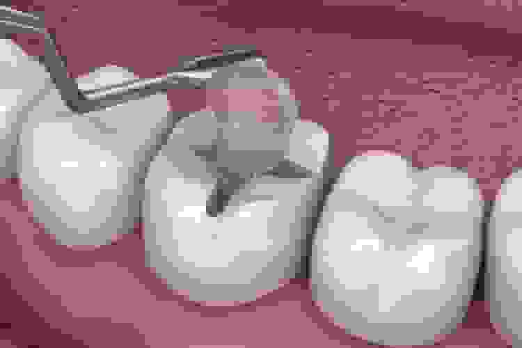 تحول در جراحی دندان‌پزشکی با اسفنج ژلاتینی سه‌عملکردی