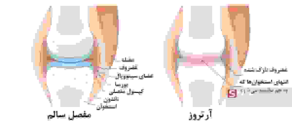 پیاده‌روی، دوچرخه‌سواری و شنا: راهکارهای مؤثر مقابله با آرتروز