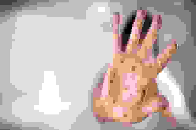 کانادا وضعیت عاری از سرخک خود را از دست داد