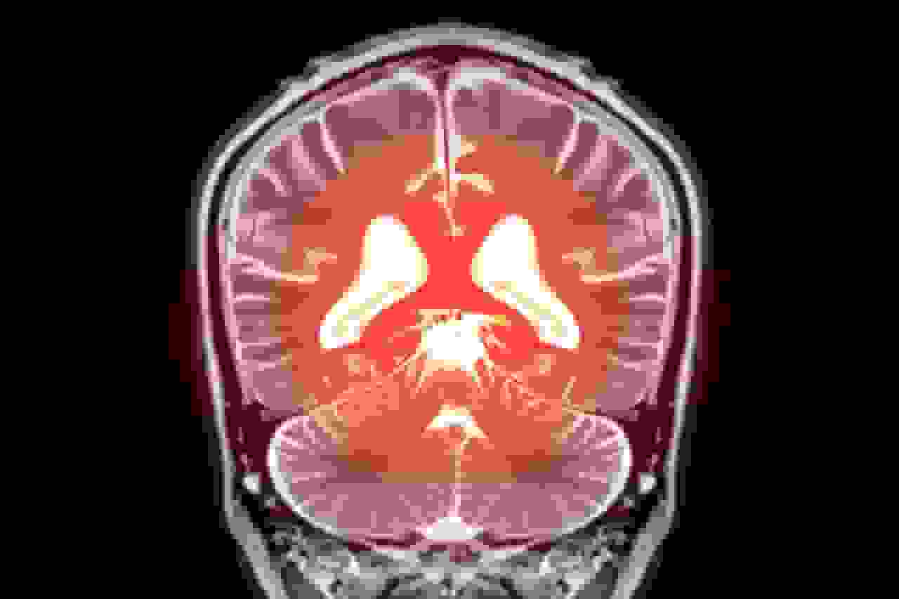 کشف امیدوارکننده برای درمان زوال عقل: کنترل پروتئین Piezo1 فشار خون مغز را اصلاح می‌کند