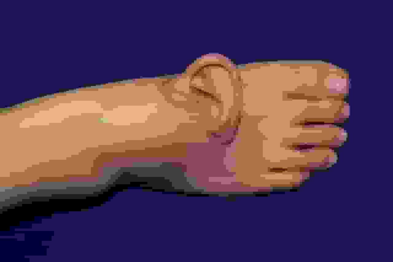 پیوند گوش بیمار به پا توسط پزشکان چینی