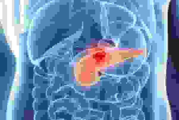شناسایی علامت هشداردهنده اولیه سرطان لوزالمعده معروف به «قاتل خاموش»