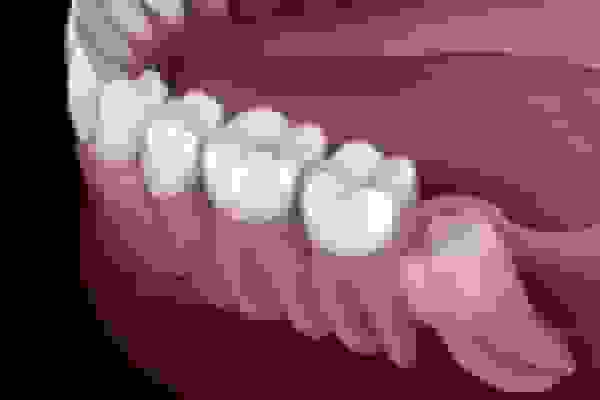 بیماری لثه خطر سکته مغزی را افزایش میدهد