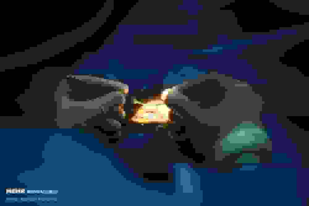 روش نوین درمان زخمهای شدید قرنیه با سلولهای بنیادی