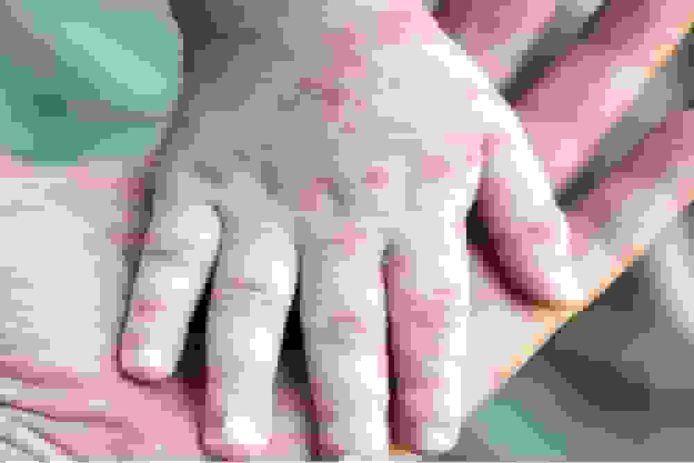 مرگ نوزاد بر اثر سرخک در کانادا در بحبوحه شیوع گسترده