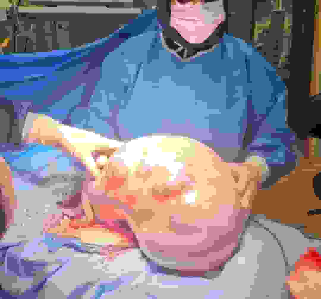 خروج موفقیتآمیز توده بزرگ شکمی از بیمار در البرز