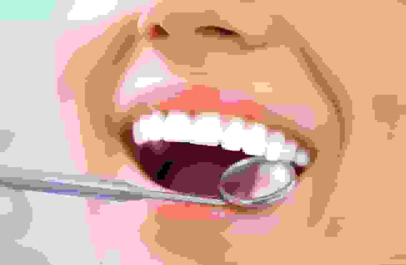 ژل ترمیمکننده مینای دندان توسط دانشمندان بریتانیایی